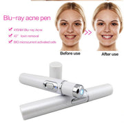 Skinex | Blue Light Acne Laser Pen - BeautyToon