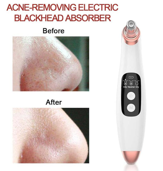 Skinworks | Blackhead Remover with Display - BeautyToon