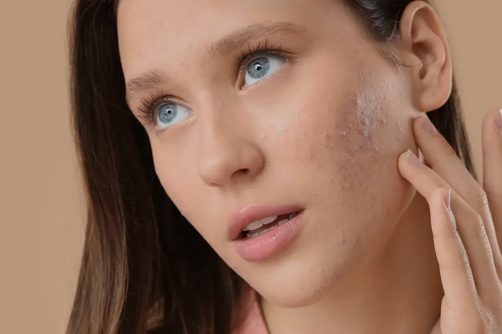Acne scar