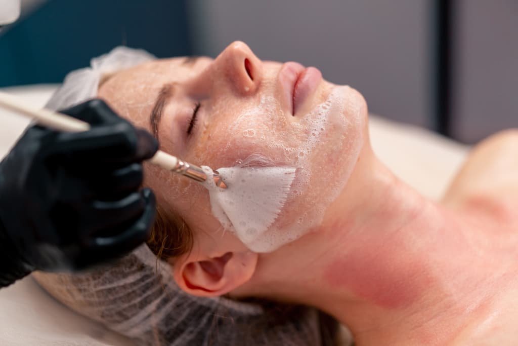 Chemical peel 03